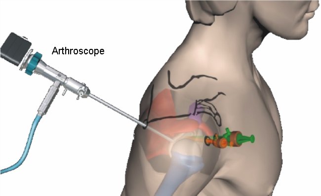 Artroscopia Ombro