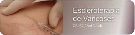 Escleroterapia Varizes