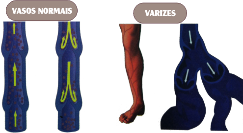 Cirurgia Varizes