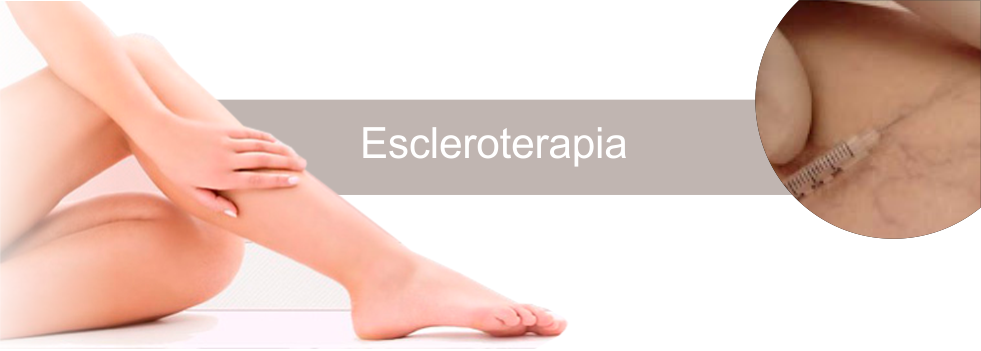 Escleroterapia